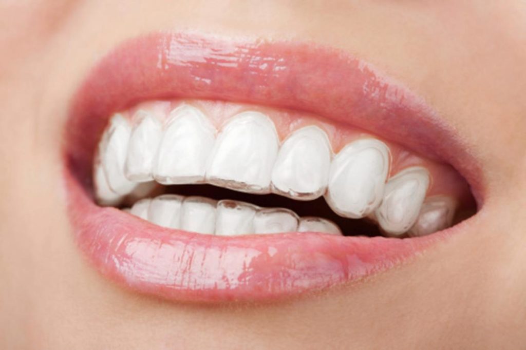 Invisalign, la ortodoncia transparente 