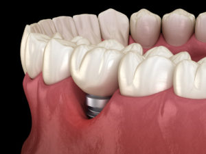 pérdida diente implantes dentales