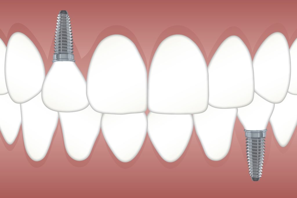 implantes dentales