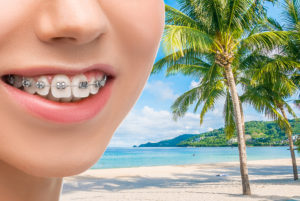 cuidar tu ortodoncia durante las vacaciones