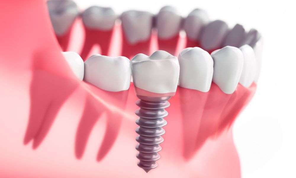 implantes dentales