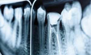endodoncia
