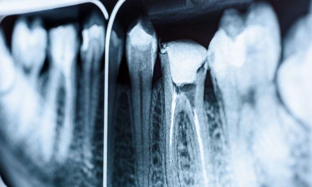 endodoncia