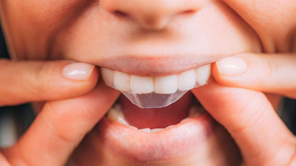 Blanqueamiento dental