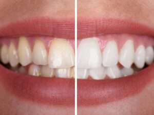 Dientes amarillos aunque los cepille