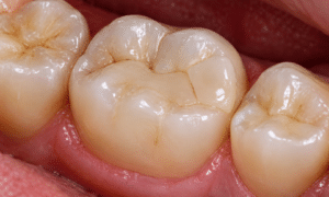 Incrustación dental
