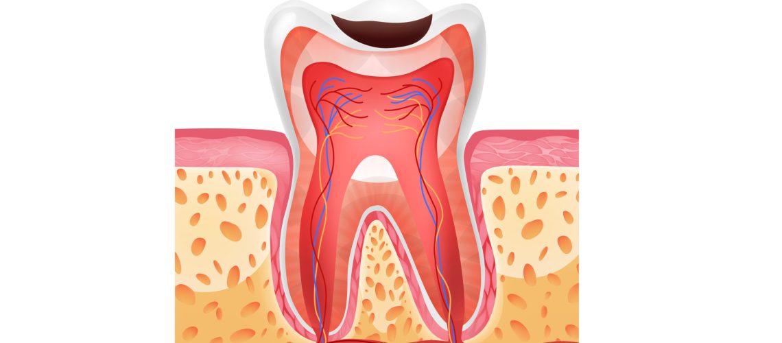 Realistic tooth structure with medium and deep caries vector illustration
