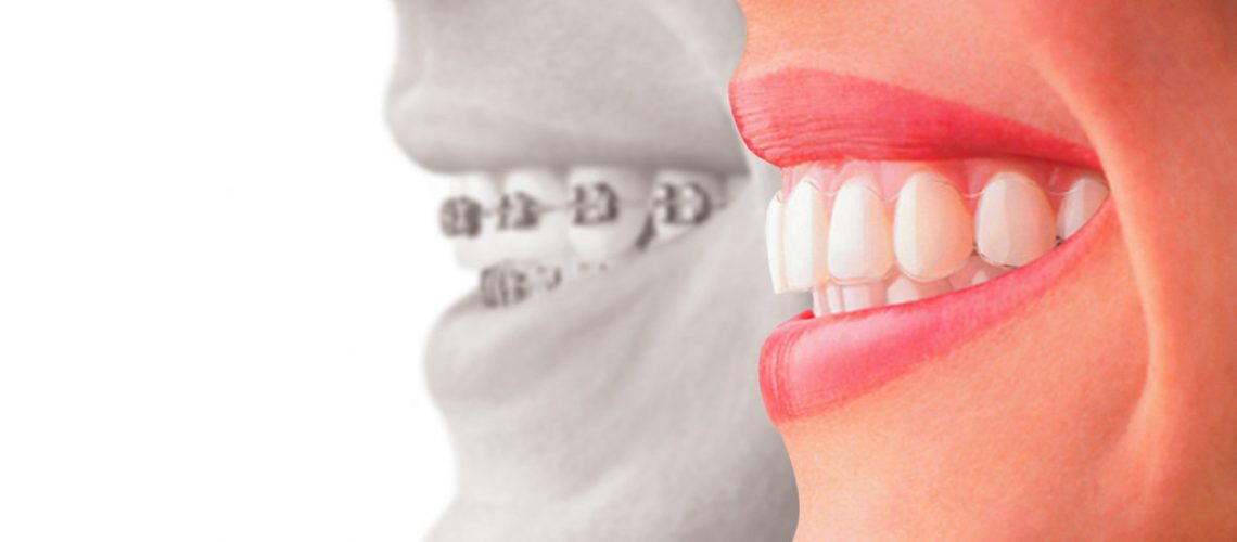duele la ortodoncia Invisalign
