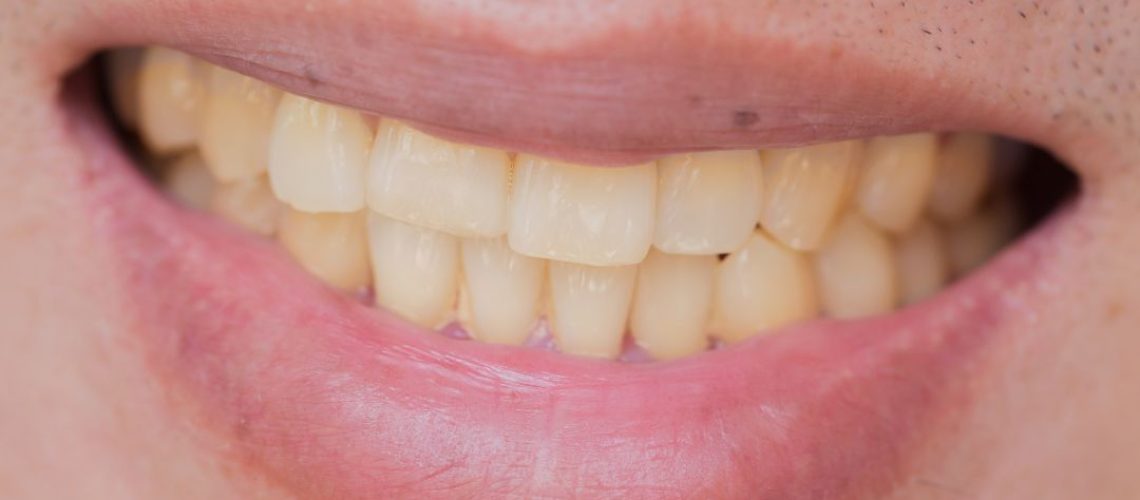 dientes amarillos