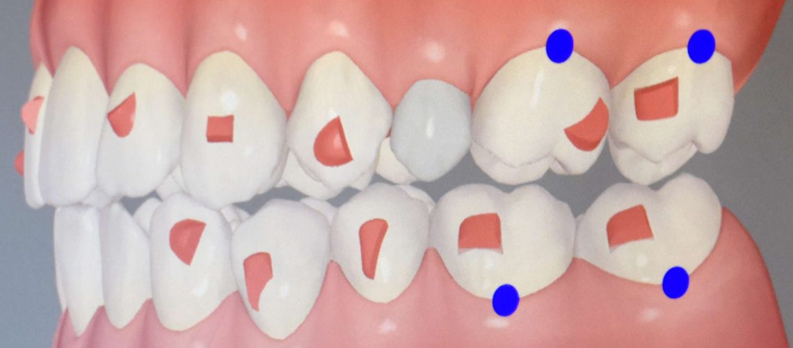 ortodoncia invisible