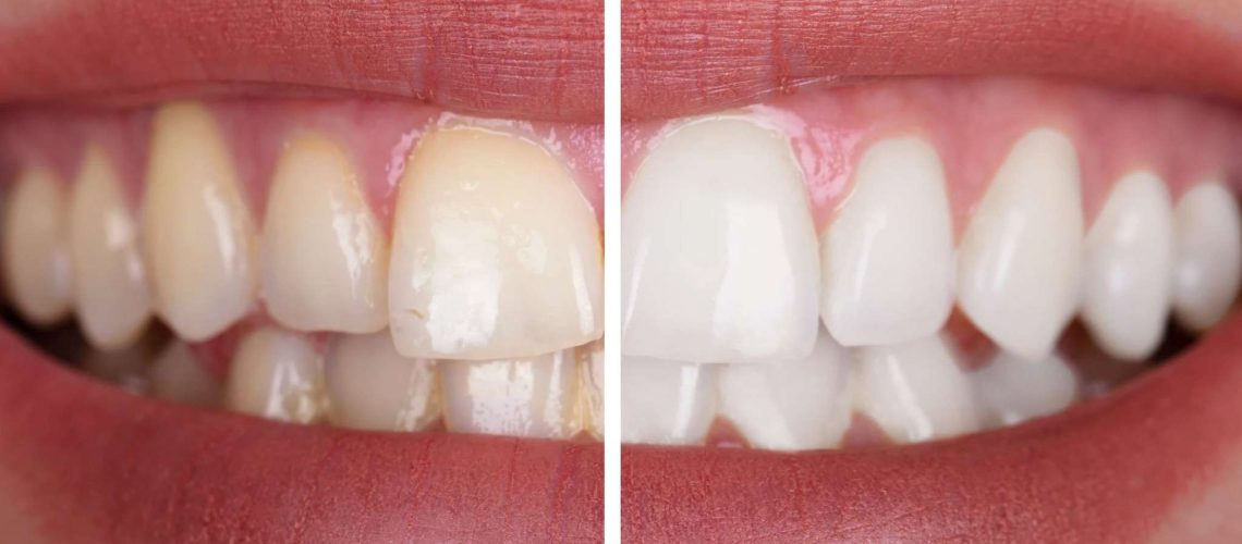 Dientes amarillos aunque los cepille