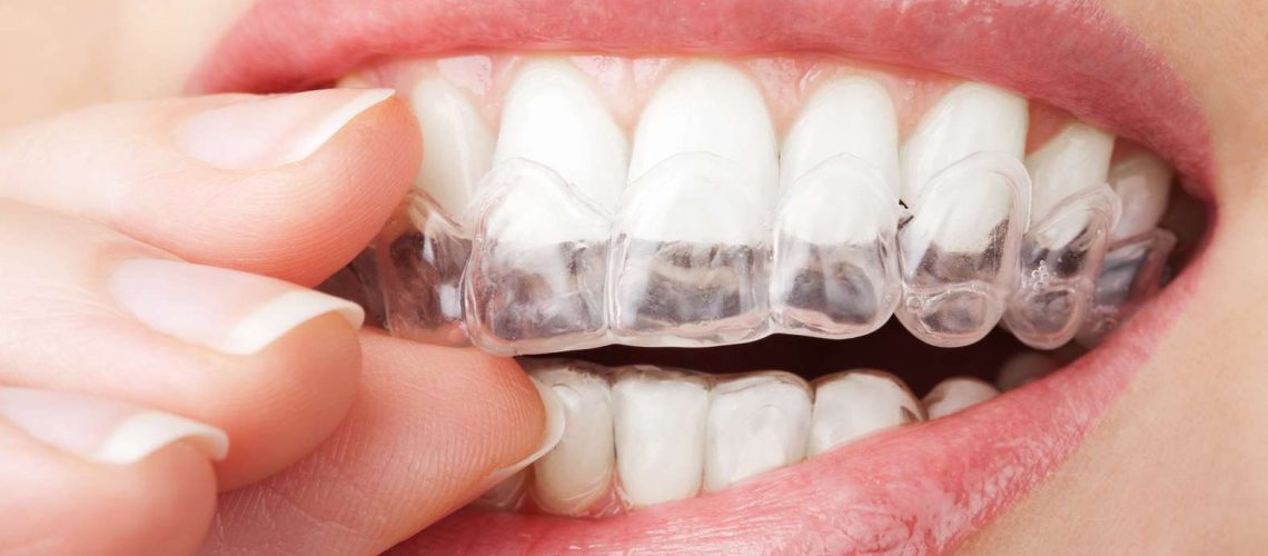 limpiar Invisalign valdivia y armijo clinica dental en Málaga