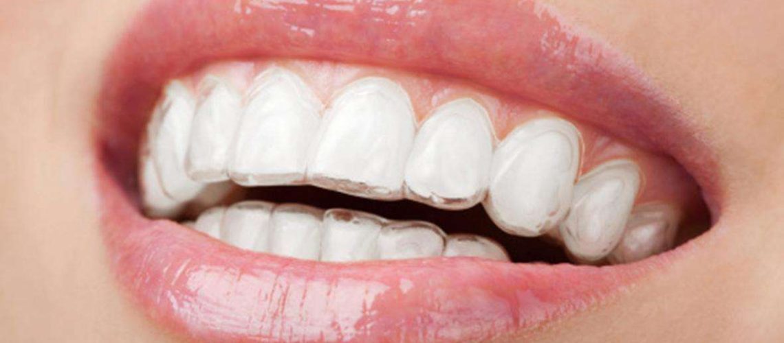 Invisalign, la ortodoncia transparente 