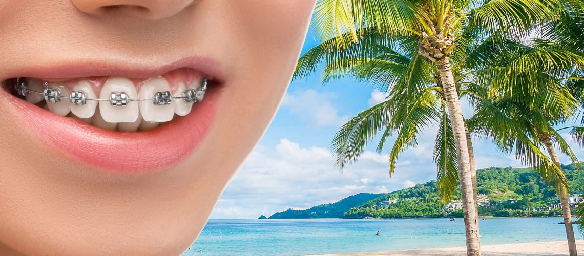 cuidar tu ortodoncia durante las vacaciones