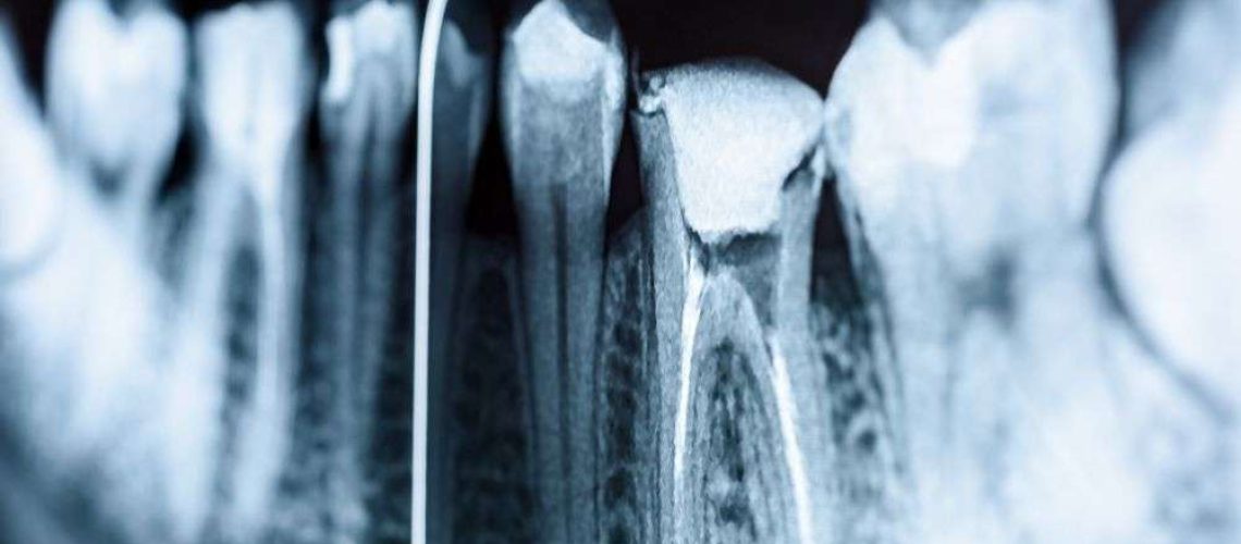 endodoncia