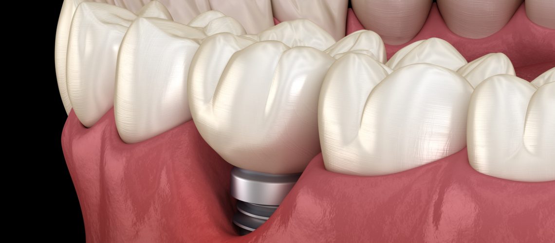 pérdida diente implantes dentales
