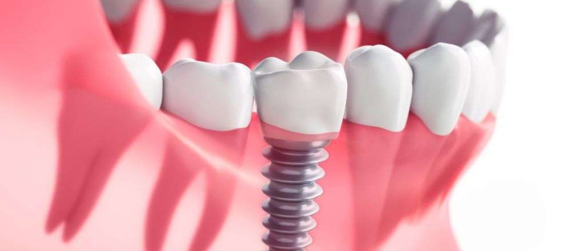 implantes dentales