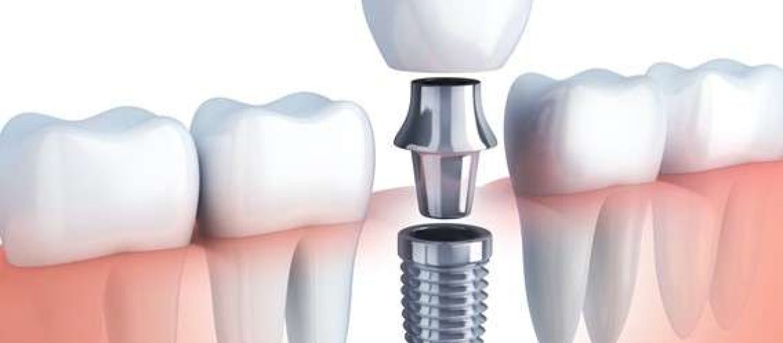 implantes dentales