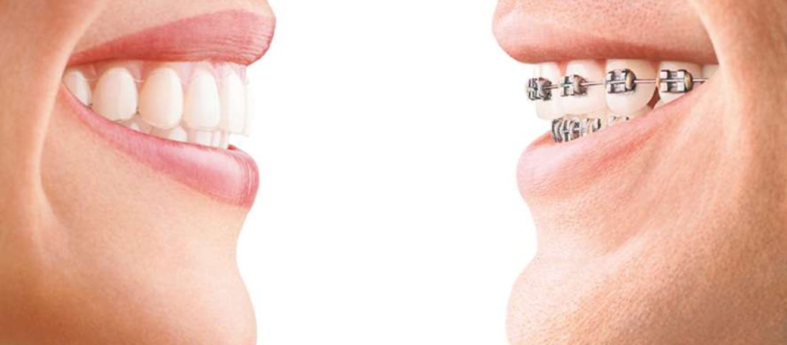 razones para elegir Invisalign
