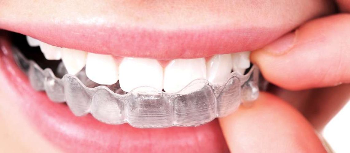 consejos para utilizar invisalign