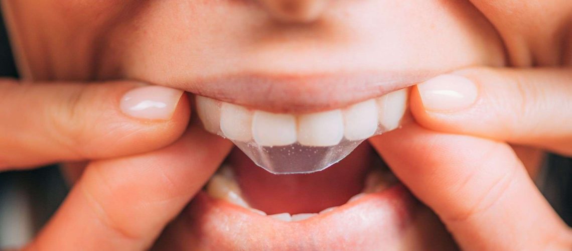 Blanqueamiento dental
