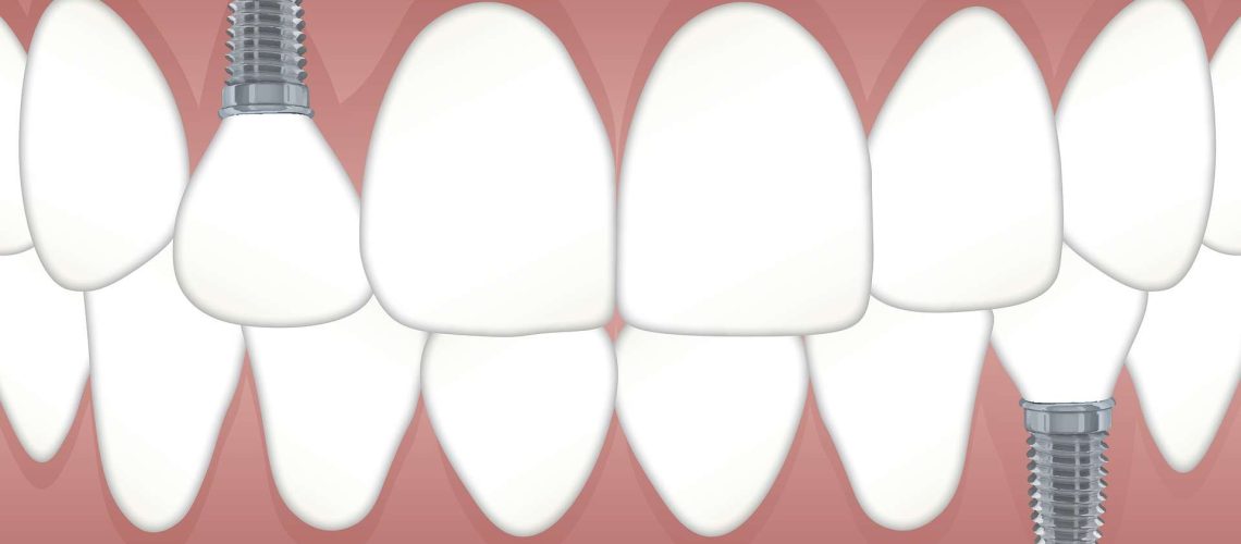 implantes dentales